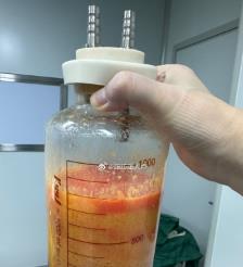本溪水动力吸脂手术要做多久？